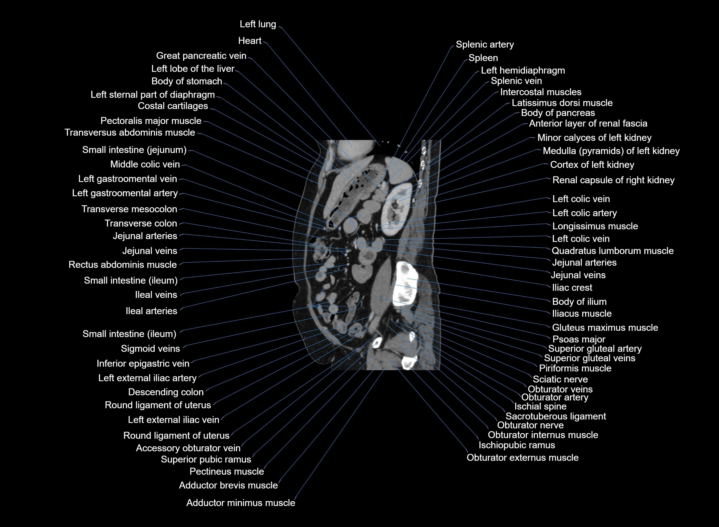 CT Abdomen sagittal cross sectional anatomy labelled radiology image -00039.webp
